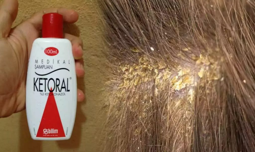 Ketoral Şampuan Nereden Alınır