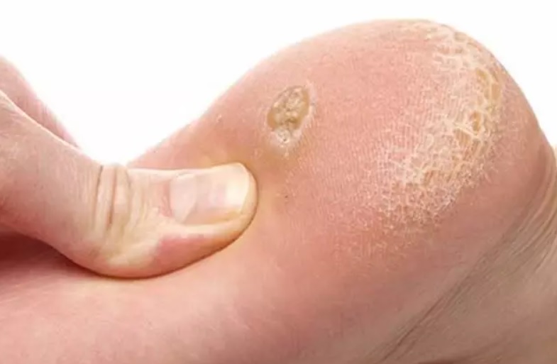 Ayak Mantar İlacı Reçetesiz Satılır mı?