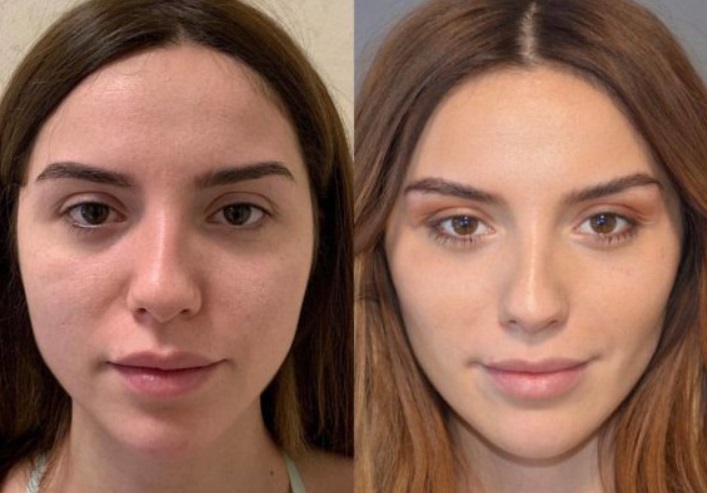 Bişektomi Ameliyatı Sonuçları