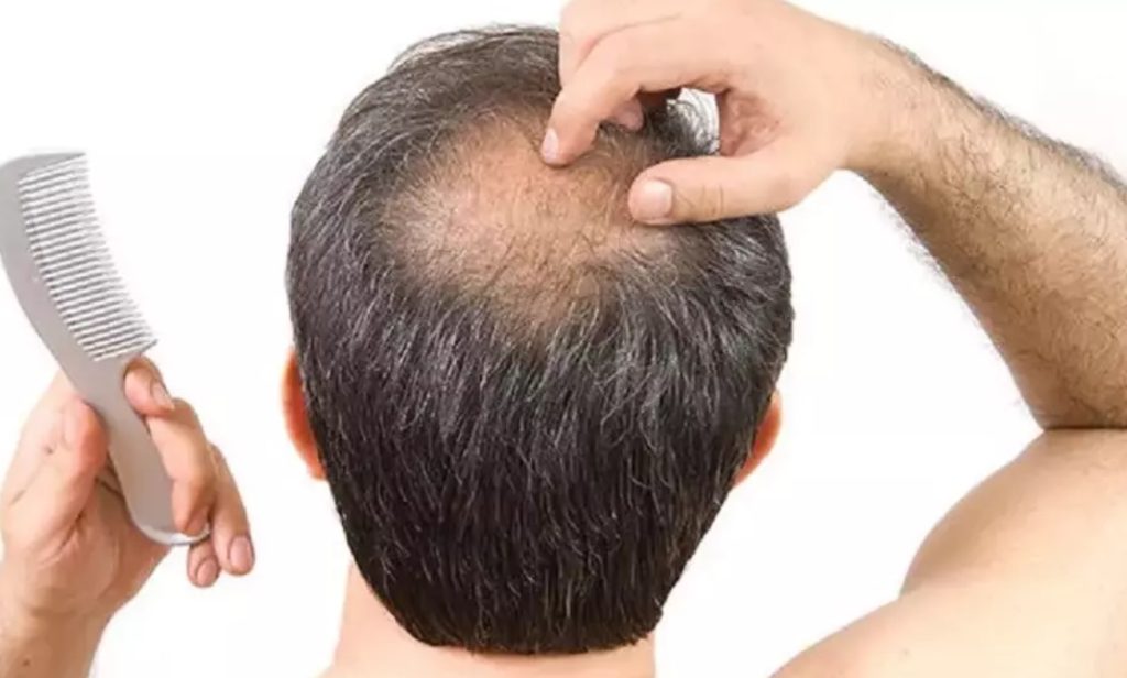 Saç Lazeri Yaptıranların Yorumları