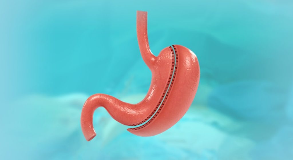 Tüp Mide Ameliyatı Olup Pişman Olanlar