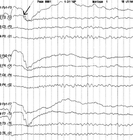 EEG ile Neler Tespit Edilir?