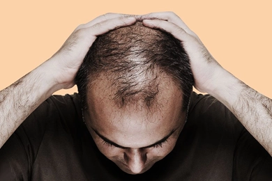 Erkek Tipi Saç Dökülmesi Nedir ?