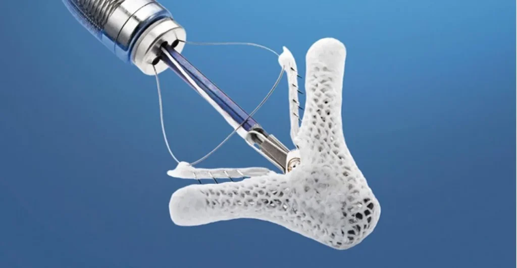 Mitraclip SGK karşılıyor mu ?