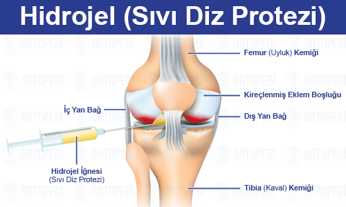 Sıvı Diz Protezi ile Yenilikçi Ağrı Tedavisi